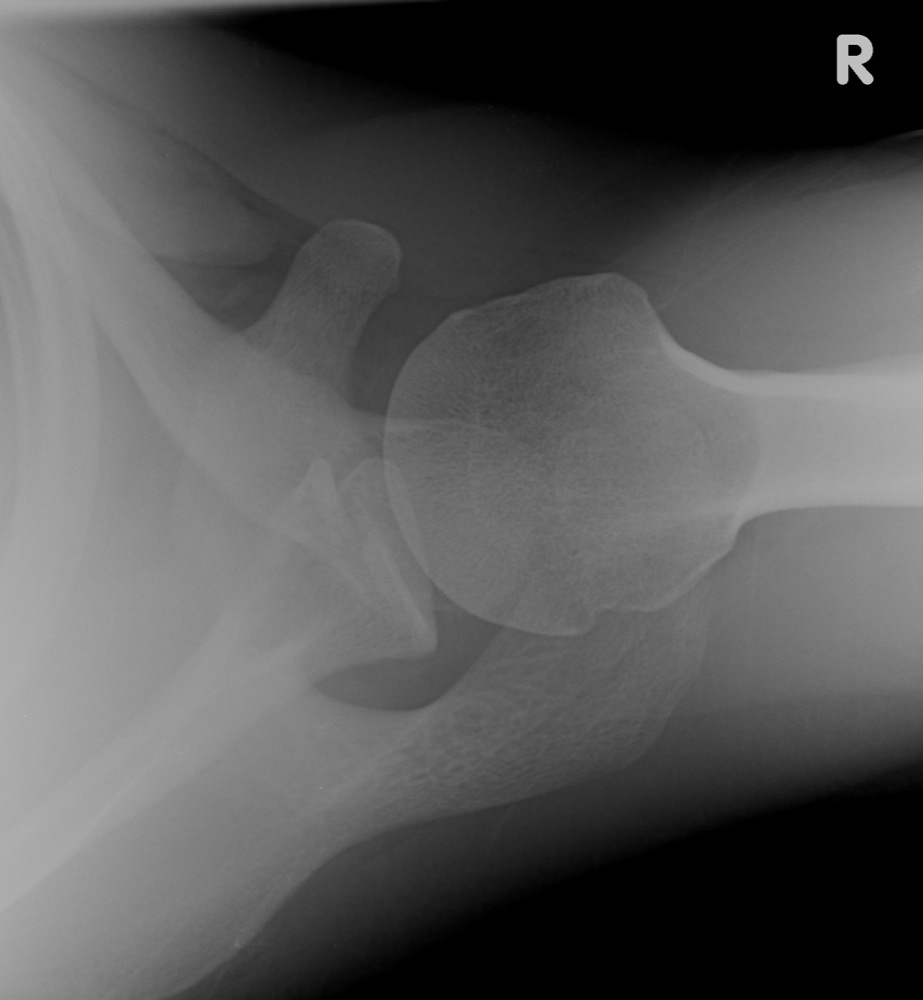 AP Hip, AP Shoulder, and Axial Shoulder X-rays ^[http://medical-imaging2012.blogspot.com/2012/02/how-to-take-x-rays.html]