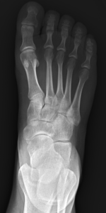 AP Hip, Oblique, and Lateral X-rays of the Foot ^[http://orthopedicgallery.com/portfolio/foot-x-ray/]