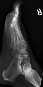 AP Hip, Oblique, and Lateral X-rays of the Foot ^[http://orthopedicgallery.com/portfolio/foot-x-ray/]