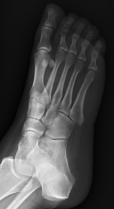 AP Hip, Oblique, and Lateral X-rays of the Foot ^[http://orthopedicgallery.com/portfolio/foot-x-ray/]